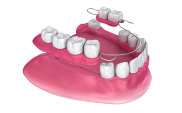 Removable Dentures